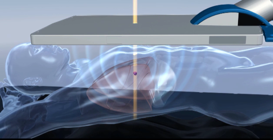 Sentara Martha Jefferson HealthWise: Calypso for lung